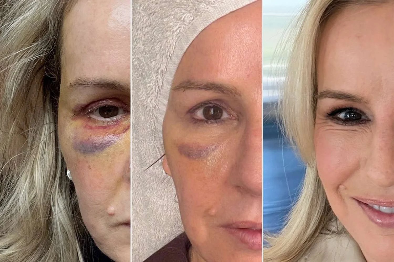 Doctor 56 Gets Bleph amid Health Journey Before-and-After Photos Exclusive Doctor 56 Gets Bleph amid Health Journey Before-and-After Photos Exclusive